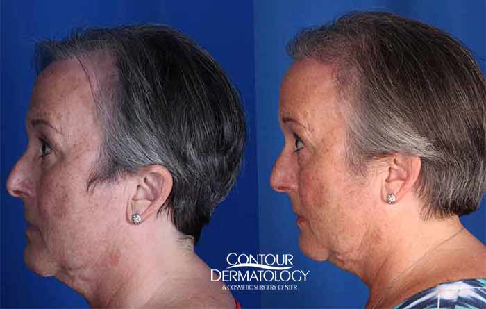 Hair Transplant and Restoration Before and After Photos