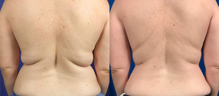 Before and after results of tumescent liposuction