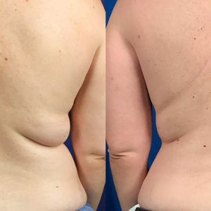 Before and after results of tumescent liposuction