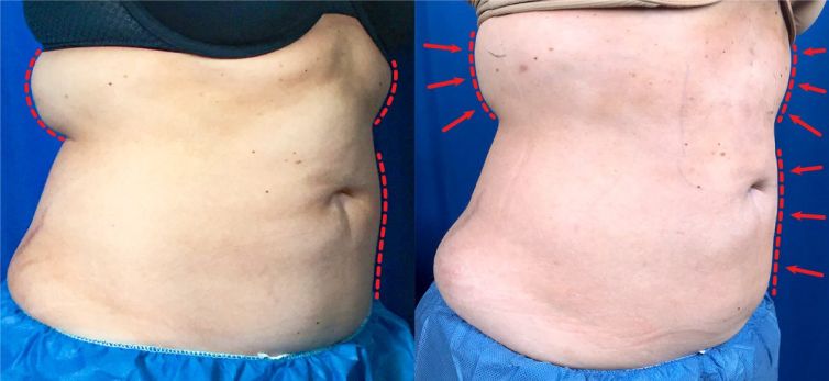 One day post treatment liposuction results of the abdomen and bra fat