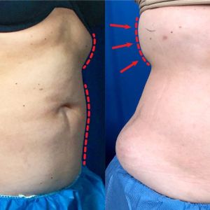 One day post treatment liposuction results of the abdomen and bra fat