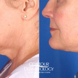 Chin Liposuction with Mini Facelift combination treatment
