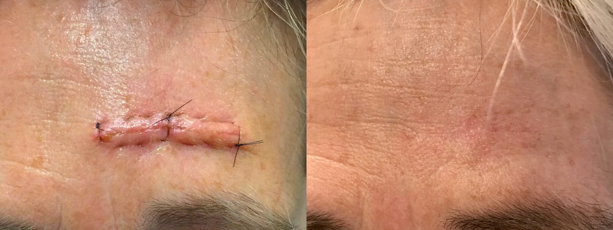 Scar revision after Mohs Surgery