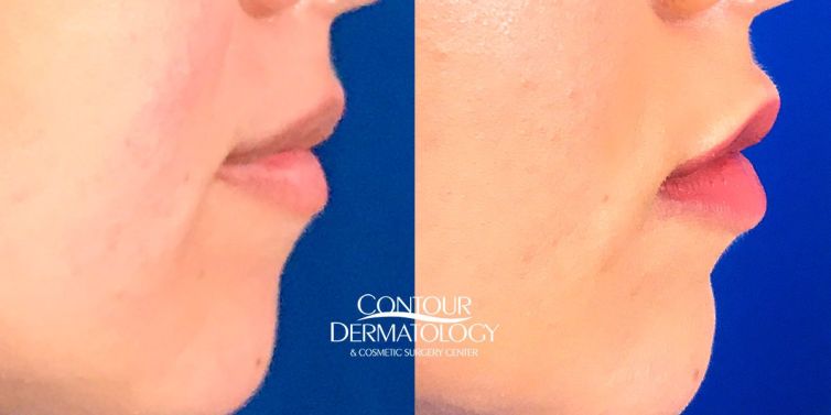 Filler results of 1ml Restylane Defyne in the lips