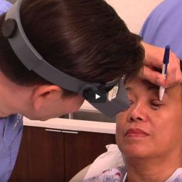 Blepharoplasty Procedure - Upper and Lower Eyelid Surgery