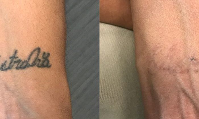 Laser Tattoo Removal on Wrist