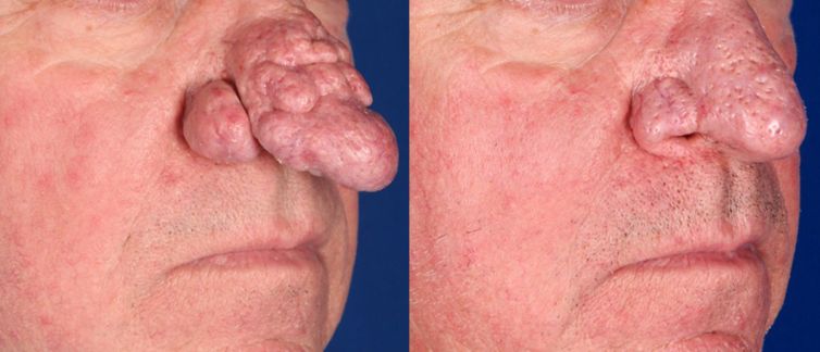 Rhinophyma after 3 Fractional CO2 Laser treatments