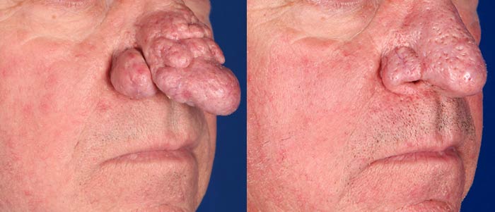 Rhinophyma after 3 Fractional CO2 Laser treatments