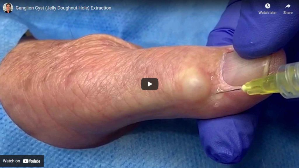 Ganglion cysts are noncancerous lumps that most commonly develop along the tendons or joints of your wrist or hand. They also may occur in the ankles and feet.
