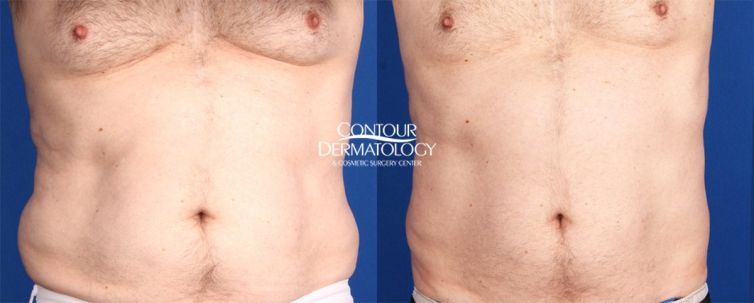 CoolSculpting Abdomen and Flanks