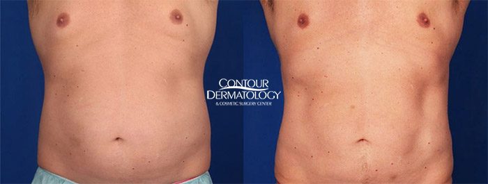 CoolSculpting Abdomen, Flanks, before and after