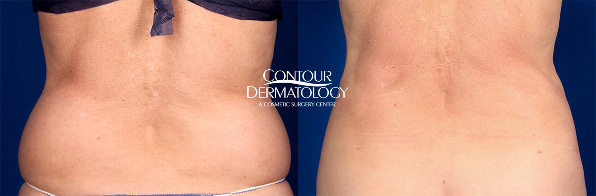 Flanks Liposuction  Before and After Photos - Palm Clinic