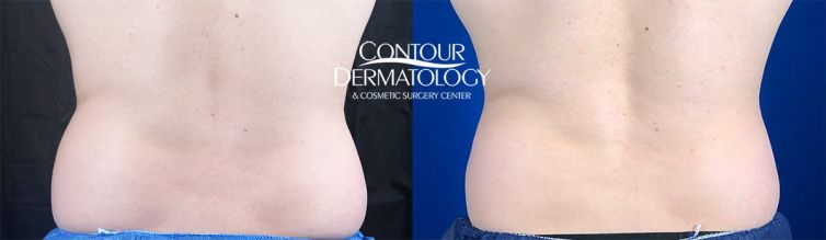 CoolSculpting Flanks, One Treatment