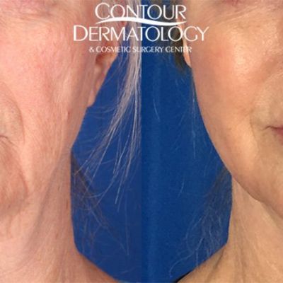 Mini Facelift with CO2, 8 Months Post Treatment
