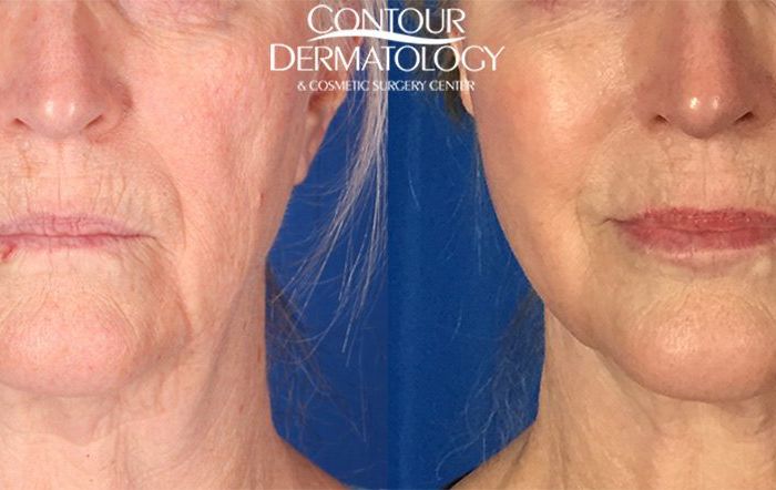 Mini Facelift with CO2, 8 Months Post Treatment
