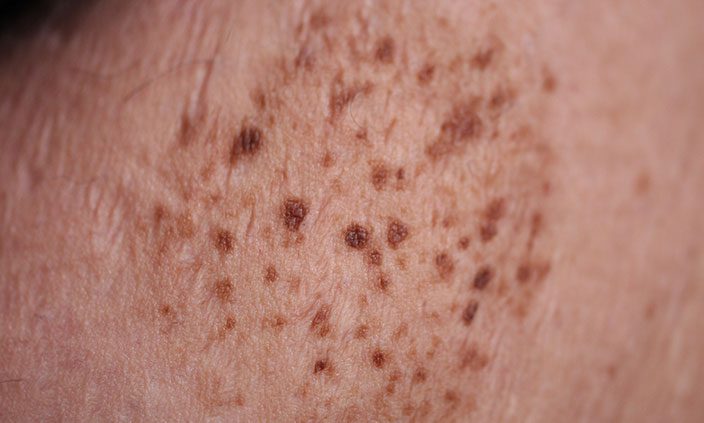 Another name for Nevus Spilus (nevi plural) is Speckled Lentiginous Nevus. The spots can be flat or raised.