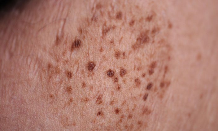 Epidermal Nevus Removal