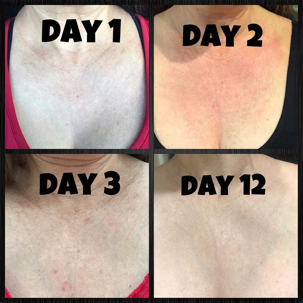 Day 1, 2, 3, 12 after Peel on chest