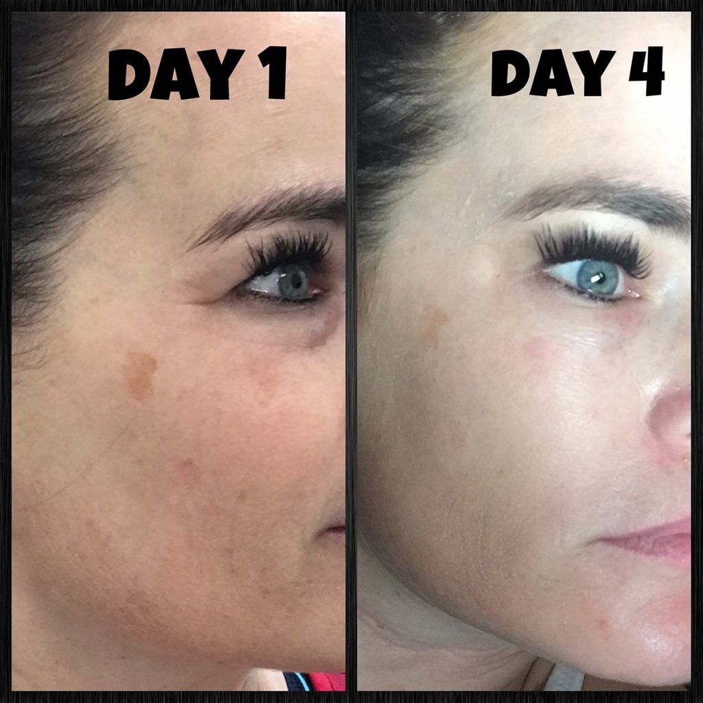 List 102+ Pictures chemical peel day by day pictures Latest