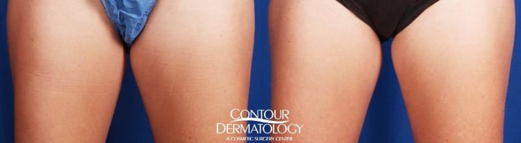 CoolSculpting, Inner Thighs, 2 Treatments, 5 Months After