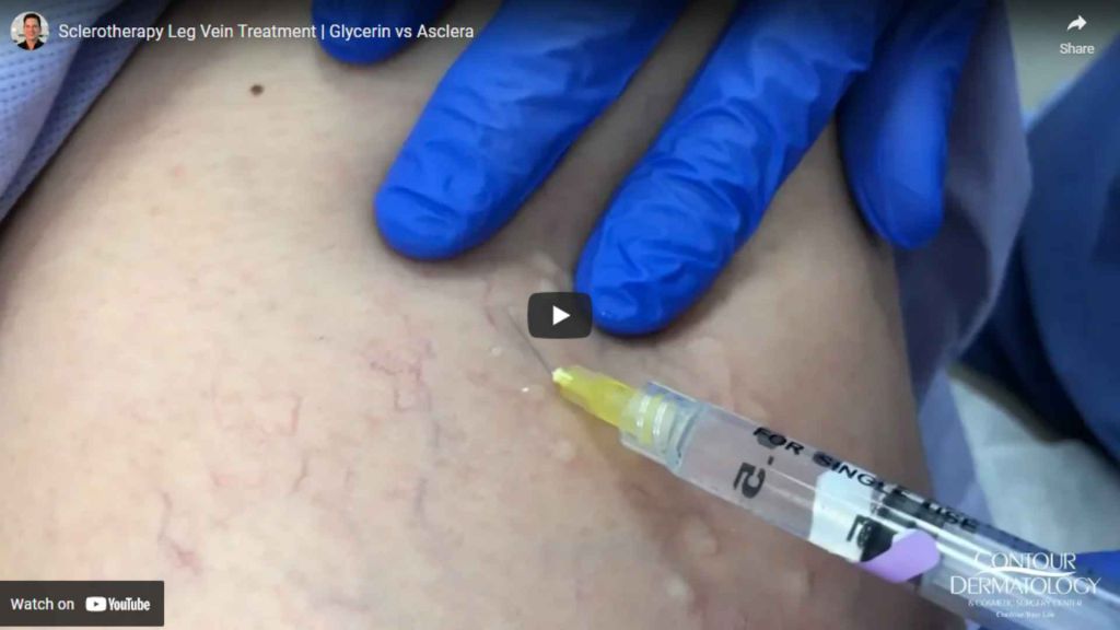 Sclerotherapy for leg vein treatment.