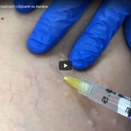 06-2019-09- Sclerotherapy for Spider Veins on Legs | Contour Dermatology