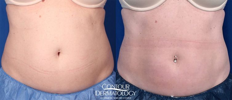 CoolSculpting for upper and lower abdomen After photo is 6 months post treatment