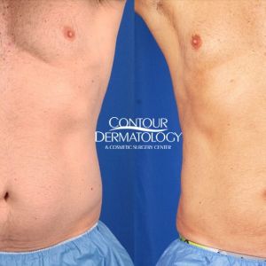 Liposuction abdomen/flanks