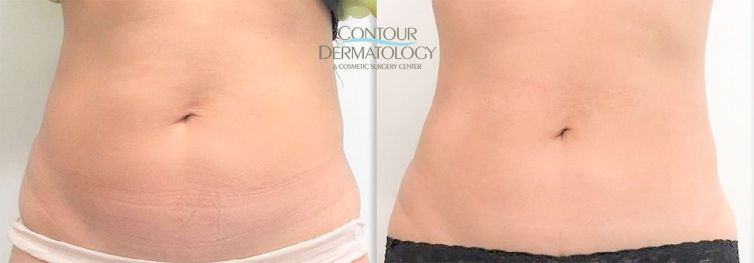 CoolSculpting and VelaShape III for Abdomen, One month after 2 treatments