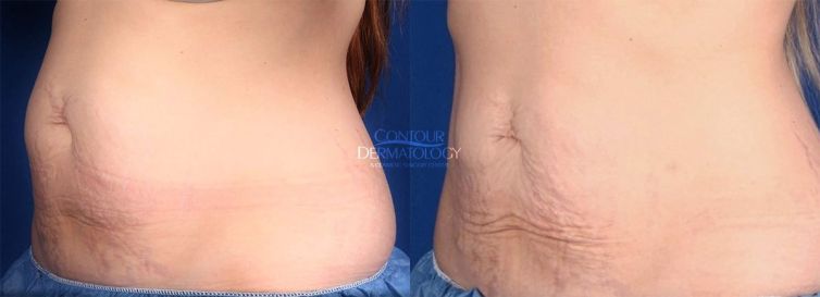 2 Treatments of CoolSculpting and VelaShape on Abdomen