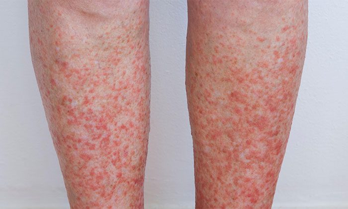 Spot This Rash–Summertime– Sun Sensitivity - Sutton Dermatology +  Aesthetics Ctr