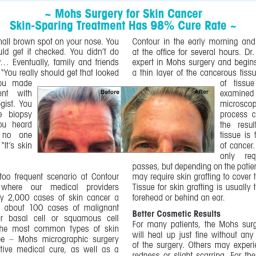 20151215-Mohs-Surgery-for-Skin-Cancer | Contour Dermatology