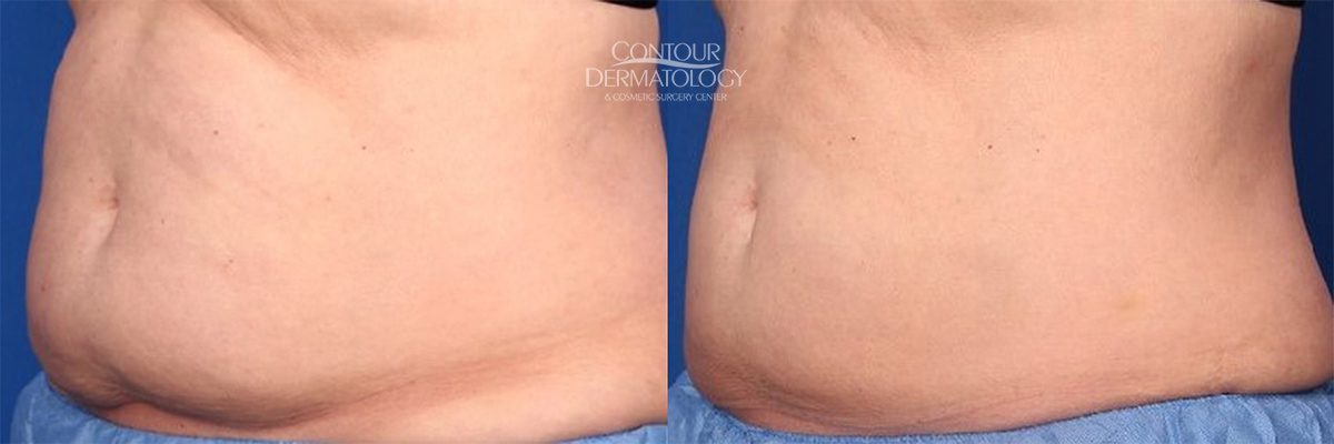 CoolSculpting - Upper & Lower Flanks Before & After Gallery - Case 4437