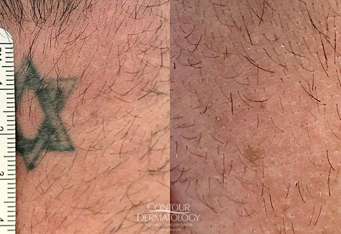 PicoWay Laser Tattoo Removal, Back of Neck