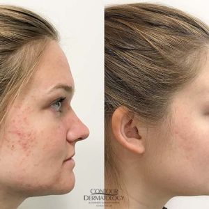 Accutane, Before & After