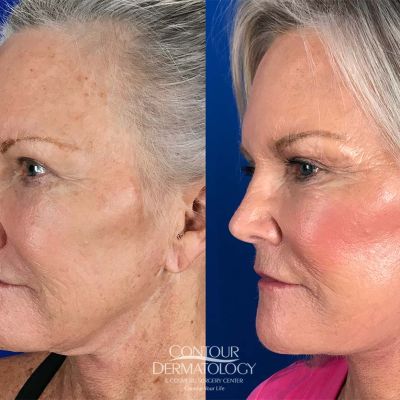 Mini Facelift, 1 month after