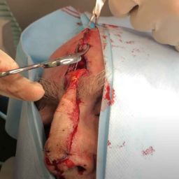Dr. Jochen performs a Paramedian Forehead Flap, also called interpolated flap, to close a defect on the tip of the nose after a Mohs Surgery.