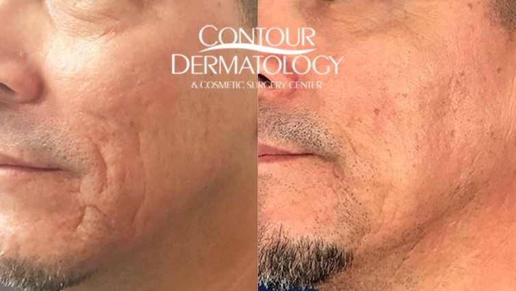 Acne Scar Treatment with Fraxel Laser, Sublative, Subscision and Filler.