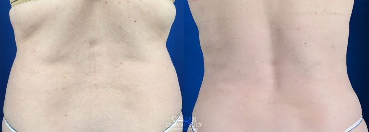 Liposculpture Flanks, 1 Month After, 52 Year Old Female