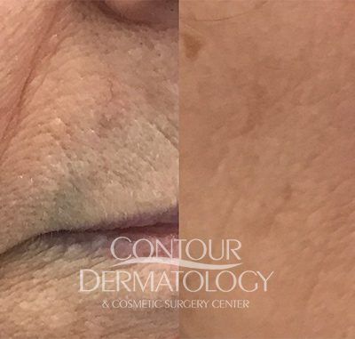 PicoWay Resolve Laser , 77 Year Old Female, 6 Months After