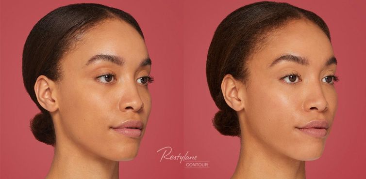 Restylane Contour Before and After Photo