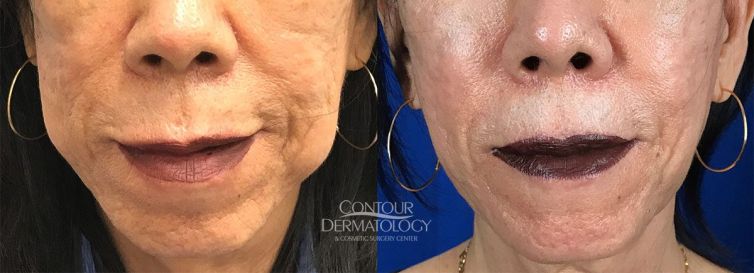Buccal Fat Reduction, Kybella, 5 vials to jowls, 6 months after treatment, 67 year old female