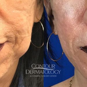 Buccal Fat Reduction, Kybella, 5 vials to jowls, 6 months after treatment, 67 year old female