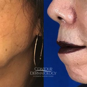 Buccal Fat Reduction, Kybella, 5 vials to jowls, 6 months after treatment, 67 year old female