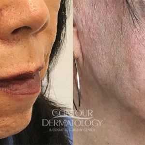Buccal Fat Reduction, Kybella, 5 vials to jowls, 6 months after treatment, 67 year old female