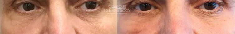 CO2 Laser Resurfacing - 50 yr old male - 3 weeks after