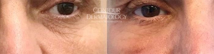 CO2 Laser Resurfacing - 50 yr old male - 3 weeks after