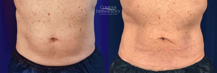 71 year old male, 2 CoolSculpting treatment to lower abdomen