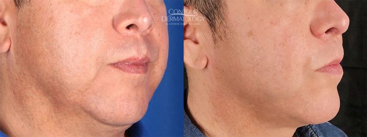 Kybella for jowls, 3 months after. 51 yr old man.