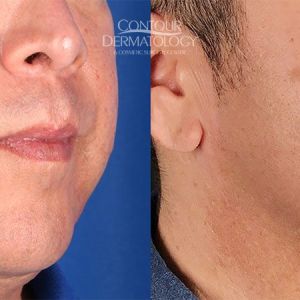 Kybella for jowls, 3 months after. 51 yr old man.